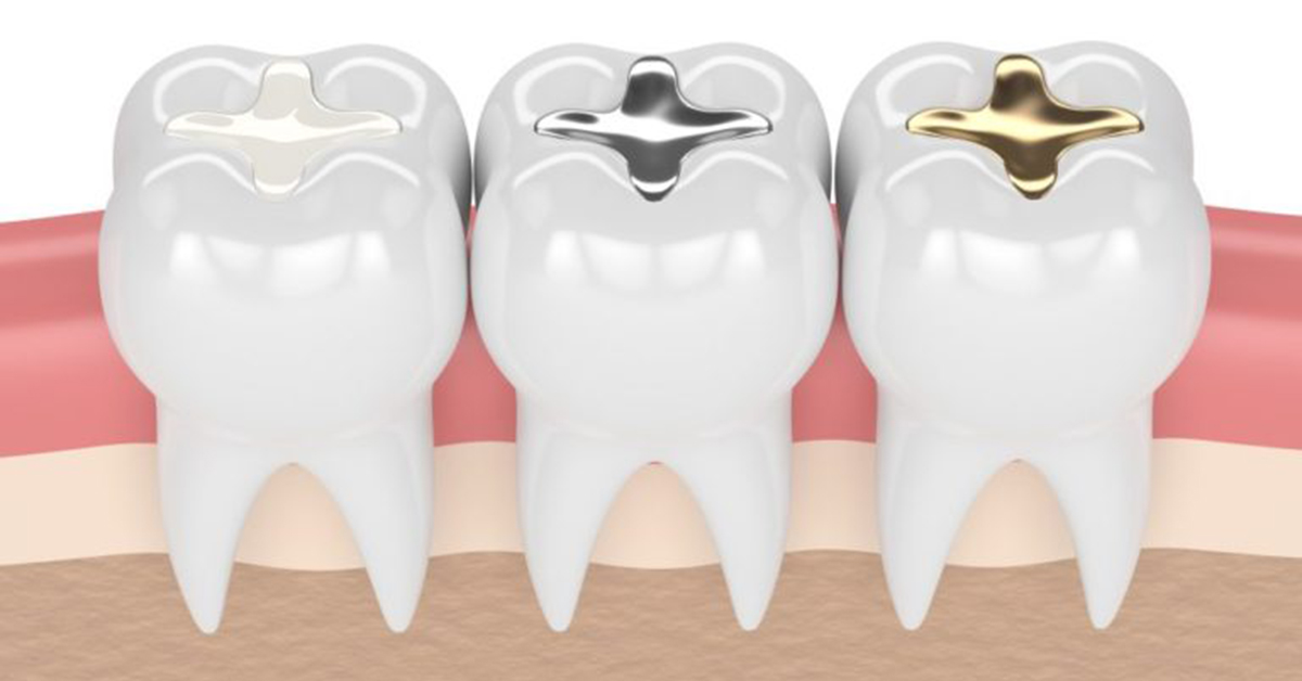 Cavities and When You Need a Tooth Filling Cavities and When You Need a Tooth Filling