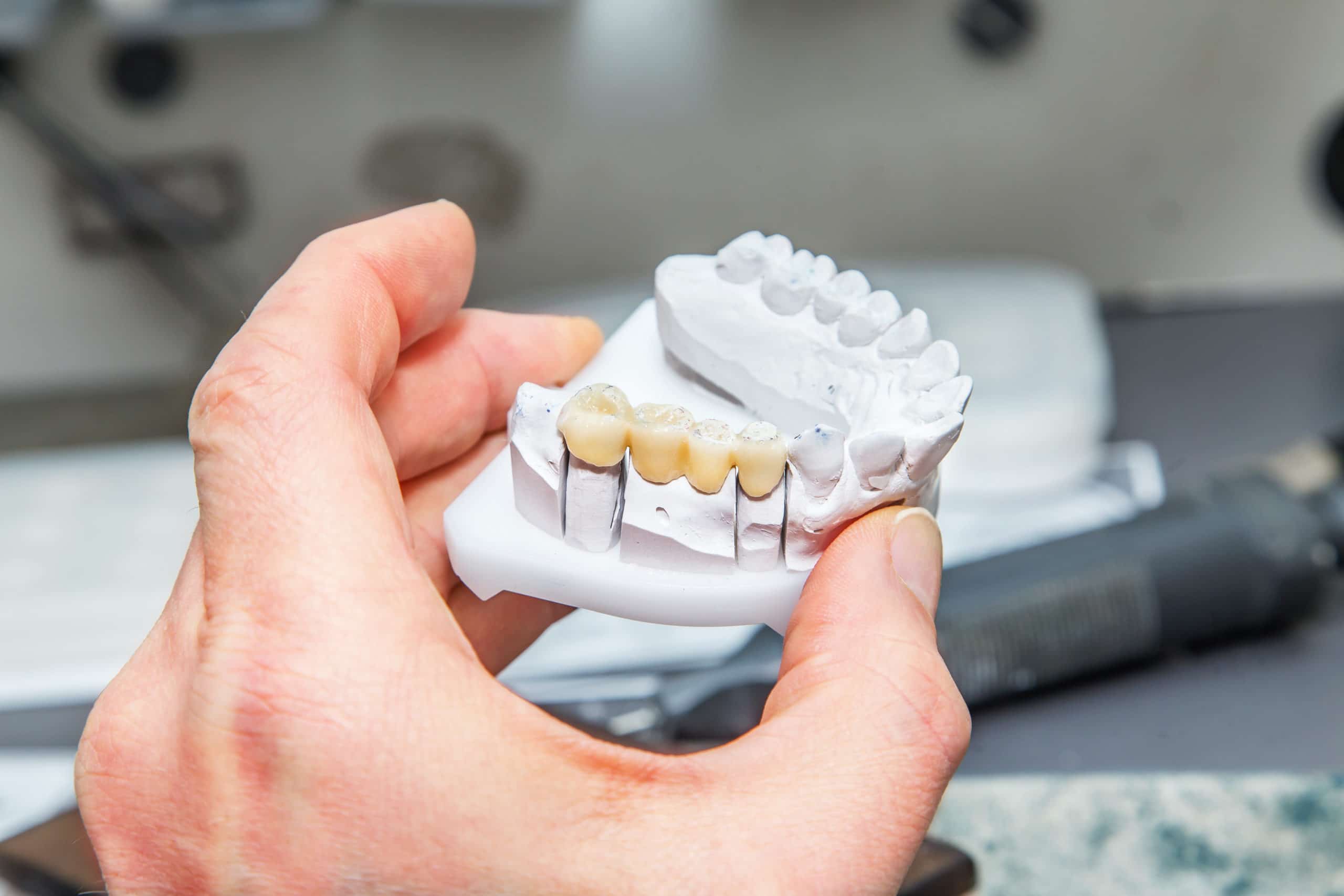 Dental Bridges for Missing Teeth in Houston Dental Bridges for Missing Teeth
